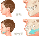 矫正须知：地包天会影响脸型！